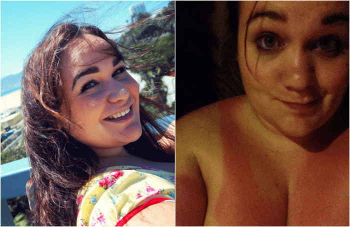 I wanted to share the embarrassing burn photo - because hopefully you'll learn the same lesson I did without the pain! WEAR SUN CREAM!